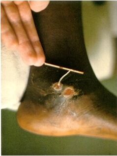 Guinea worm taken from the leg of a person suffering from dracunculiasis